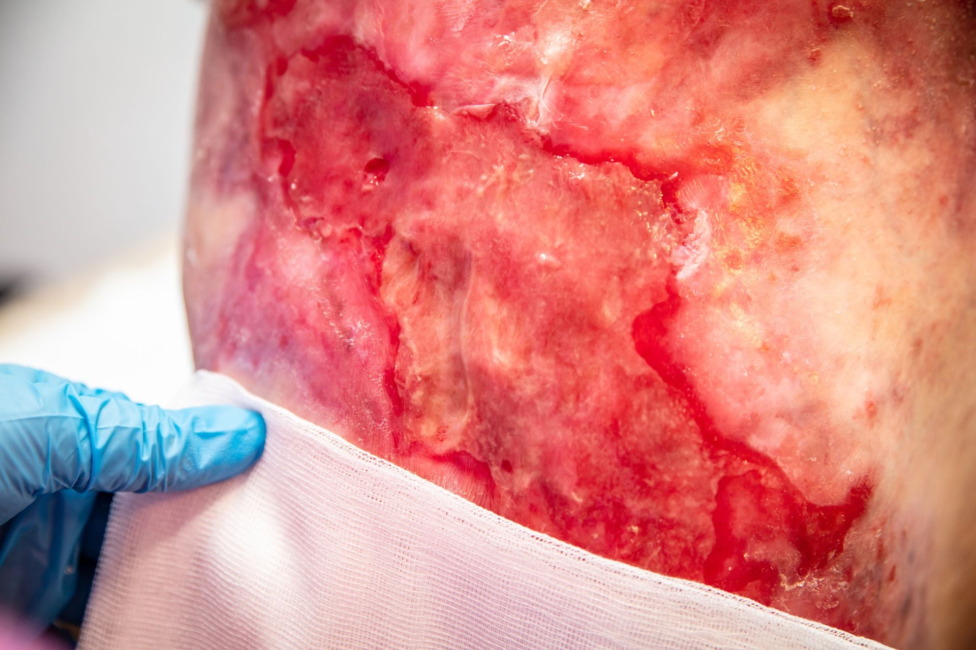 Kindler Syndrome: The Vanguards of Treatment