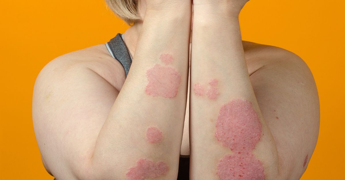 Understanding Psoriasis: Types and Triggers